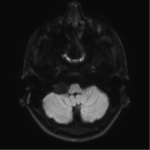 Arachnoid cyst - cerebellopontine angle (Radiopaedia 59689-67083 Axial DWI 42).png