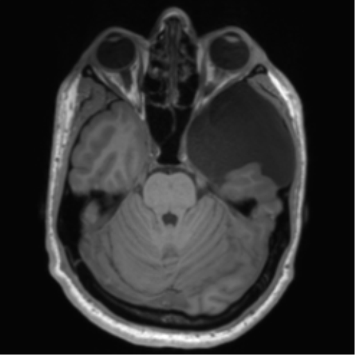 File:Arachnoid cyst with subdural hematoma (Radiopaedia 85892-101743 Axial T1 31).png