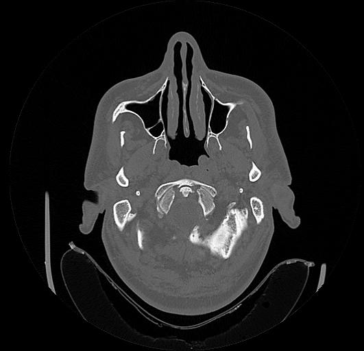Arcuate foramen (Radiopaedia 89833-106944 Axial bone window 7).jpg