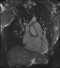 Arrhythmogenic right ventricular cardiomyopathy (Radiopaedia 57972-64966 CINE R2 SSFP 34).jpg