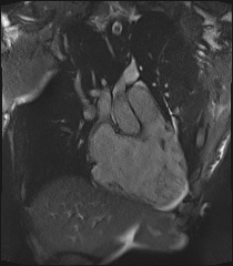 Arrhythmogenic right ventricular cardiomyopathy (Radiopaedia 57972-64966 CINE R2 SSFP 42).jpg