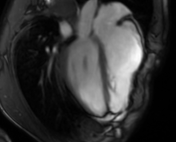 Arrhythmogenic right ventricular cardiomyopathy (Radiopaedia 69564-79464 4ch cine 81).jpg