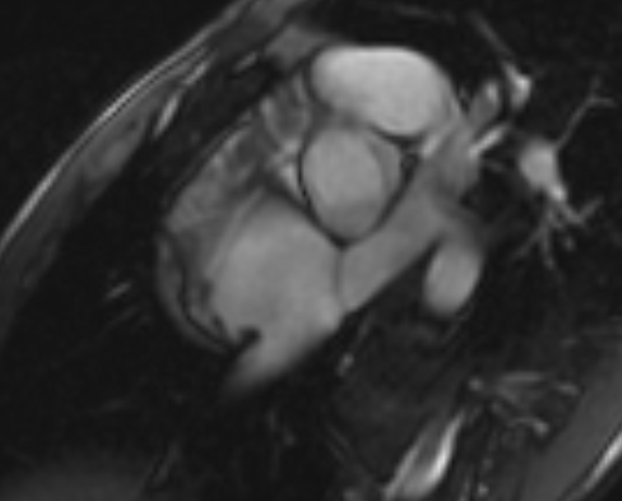 Arrhythmogenic right ventricular cardiomyopathy (Radiopaedia 69564-79464 short axis cine 284).jpg