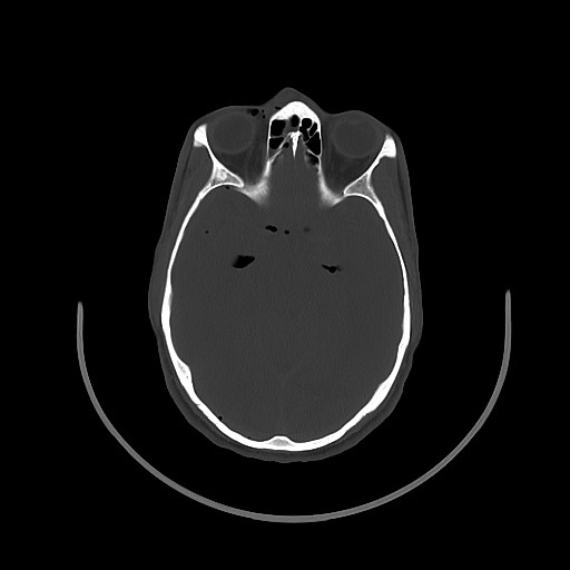 Arrow injury to the brain (Radiopaedia 72101-82607 Axial bone window 66).jpg