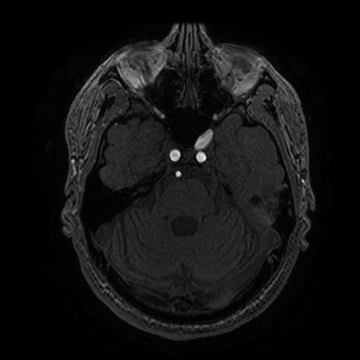 Arteriovenous malformation (Radiopaedia 71628-81999 Axial MRA 83).jpg