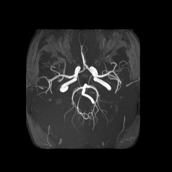 Artery of Percheron infarct (Radiopaedia 40966-43676 F 30).jpg