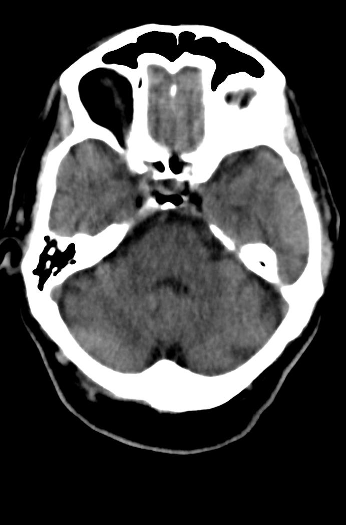 Artery of Percheron infarction (Radiopaedia 80613-94202 Axial non-contrast 61).jpg
