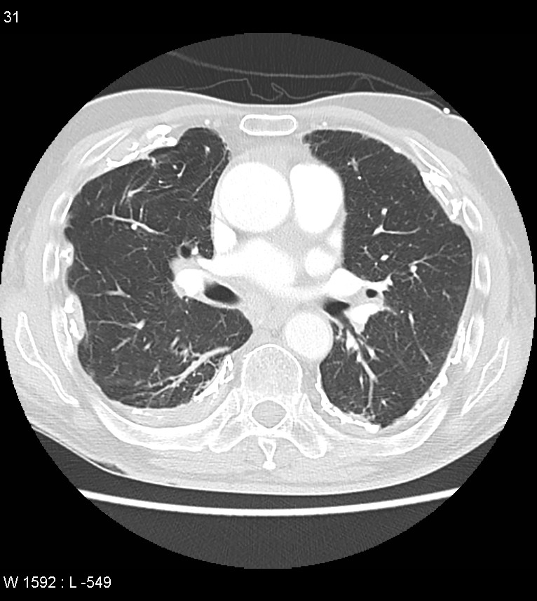 Asbestos related lung and pleural disease (Radiopaedia 14377-14301 A 28).jpg