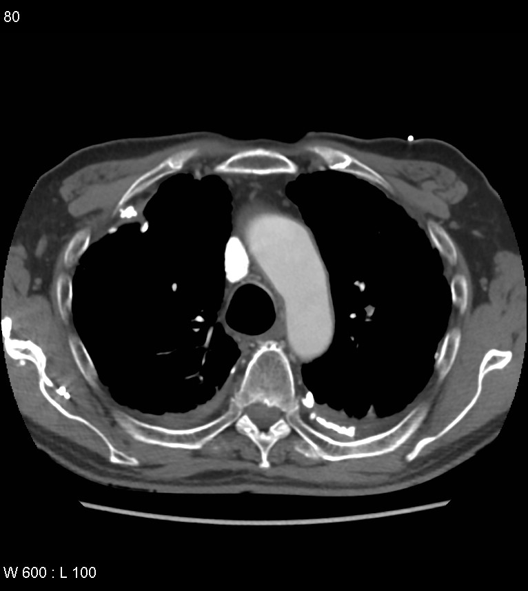 Asbestos related lung and pleural disease (Radiopaedia 14377-14301 D 16).jpg