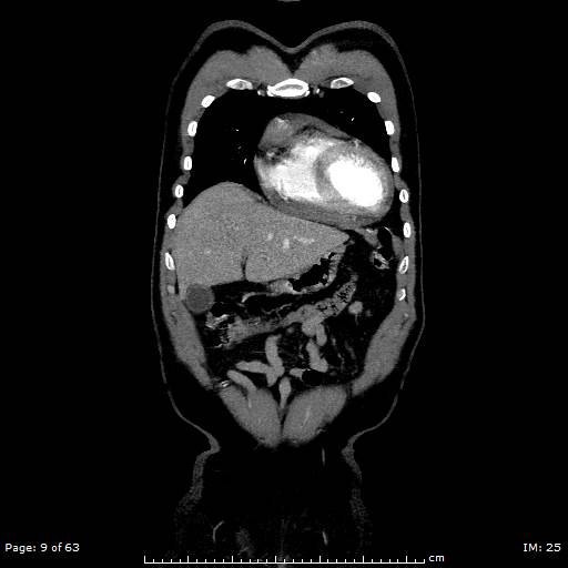 Ascending aortic aneurysm (Radiopaedia 50086-55404 B 9).jpg