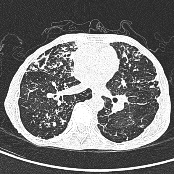 File:Aspergilloma- with Monod sign (Radiopaedia 44737-48532 Axial lung window 147).jpg