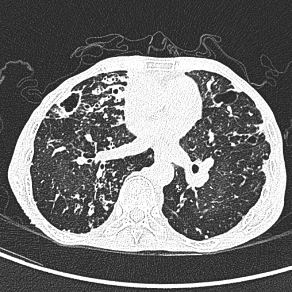Aspergilloma- with Monod sign (Radiopaedia 44737-48532 Axial lung window 151).jpg