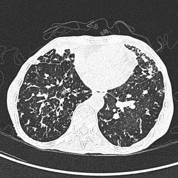 Aspergilloma- with Monod sign (Radiopaedia 44737-48532 Axial lung window 179).jpg