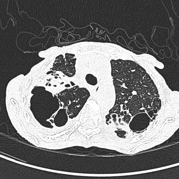 Aspergilloma- with Monod sign (Radiopaedia 44737-48532 Axial lung window 79).jpg