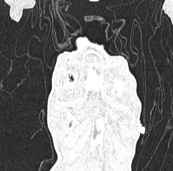 Aspergilloma- with Monod sign (Radiopaedia 44737-48532 Coronal lung window 122).jpg