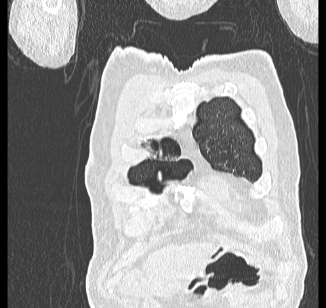 Aspergilloma (Radiopaedia 44592-48327 Coronal lung window 1).jpg