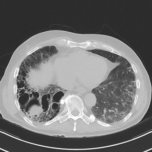 Aspergilloma on background pulmonary fibrosis (Radiopaedia 60942-68757 A 40).jpg