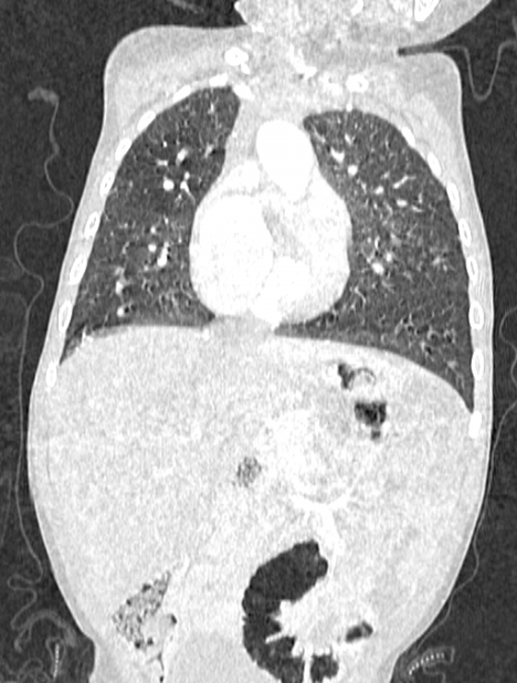 Asplenia syndrome (Radiopaedia 73083-83792 Coronal lung window 54).jpg