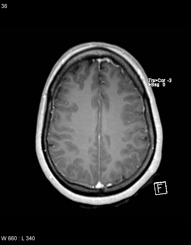Astroblastoma (Radiopaedia 39792-42218 Axial T1 C+ 35).jpg
