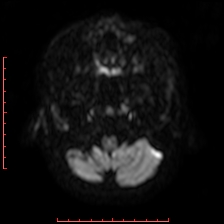 File:Astroblastoma (Radiopaedia 74287-85162 Axial DWI 4).jpg