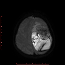 Astroblastoma (Radiopaedia 74287-85162 Axial DWI 86).jpg