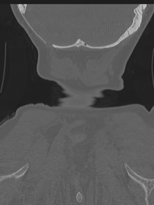 Atlanto-axial subluxation (Radiopaedia 36610-38176 Coronal bone window 52).png