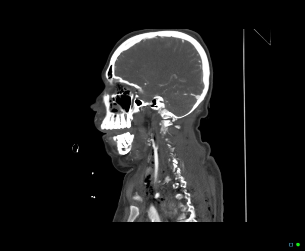 Atlanto-occipital dissociation - Traynelis type 1 (Radiopaedia 87570-103949 C 25).jpg