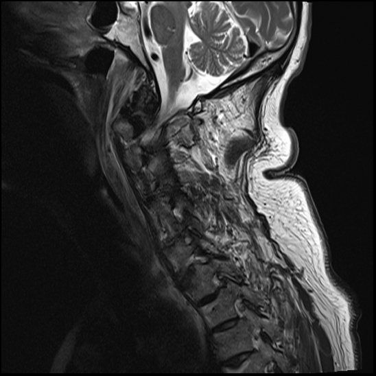 File:Atlas (type 3b subtype 1) and axis (Anderson and D'Alonzo type 3, Roy-Camille type 2) fractures (Radiopaedia 88043-104610 Sagittal T2 3).jpg