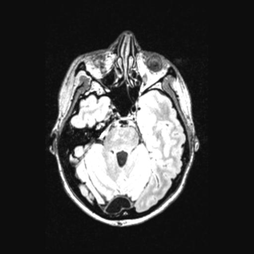 Atretic encephalocoele with inferior vermis hypoplasia (Radiopaedia 30443-31108 Axial 53).jpg