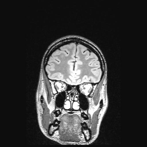 Atretic encephalocoele with inferior vermis hypoplasia (Radiopaedia 30443-31108 Coronal FLAIR 141).jpg