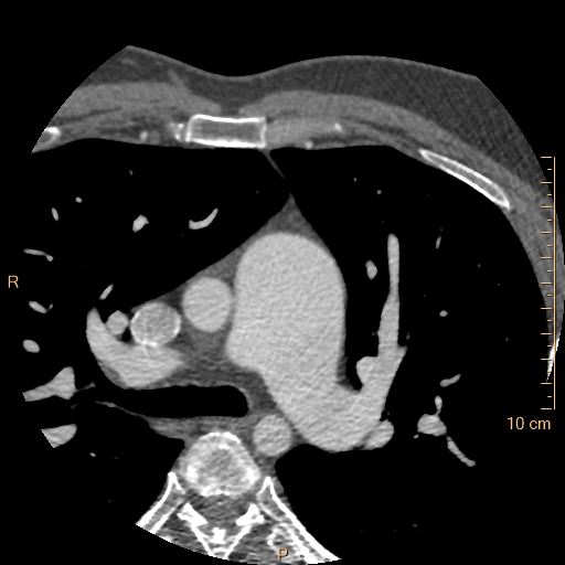 Atrial septal defect (upper sinus venosus type) with partial anomalous pulmonary venous return into superior vena cava (Radiopaedia 73228-83961 A 41).jpg