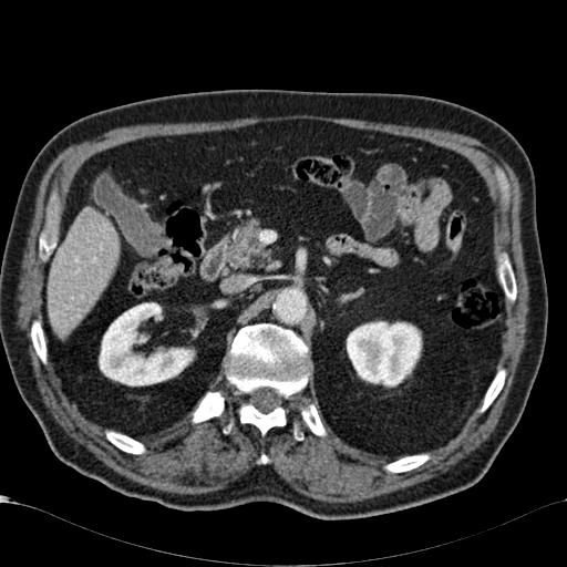 Atypical hepatocellular carcinoma (Radiopaedia 41744-44698 B 35).jpg