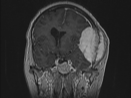 Atypical meningioma (Radiopaedia 62985-71406 Coronal T1 C+ 48).jpg