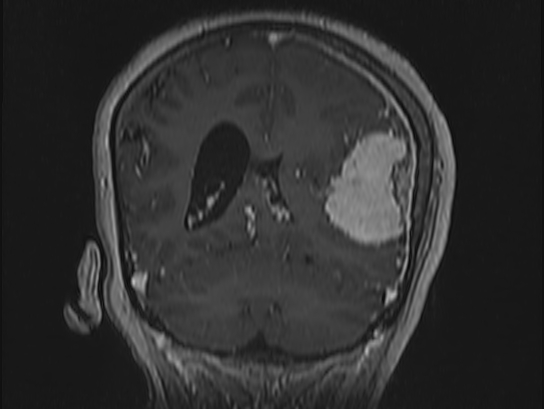 File:Atypical meningioma (Radiopaedia 62985-71406 Coronal T1 C+ 88).jpg