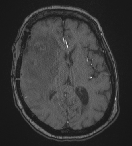 Atypical meningioma (WHO Grade II) (Radiopaedia 54742-60981 Axial MRA 53).png