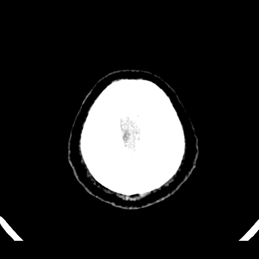 File:Atypical meningioma (WHO grade II) with brain invasion (Radiopaedia 57767-64728 Axial non-contrast 45).png