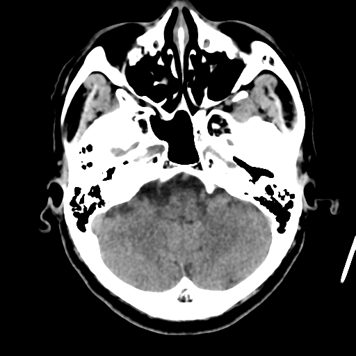 Atypical meningioma (WHO grade II) with osseous invasion (Radiopaedia 53654-59715 Axial non-contrast 13).png