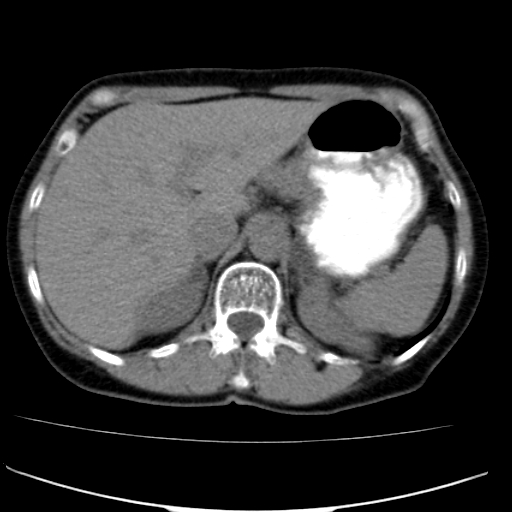 File:Atypical renal cyst (Radiopaedia 17536-17251 non-contrast 5).jpg