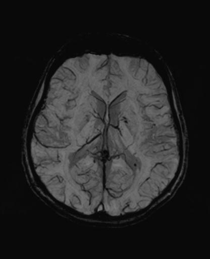 Autoimmune limbic encephalitis (Radiopaedia 30363-31005 SWI - mIP 40).jpg