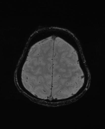Autoimmune limbic encephalitis (Radiopaedia 30363-31005 SWI - magnitude 66).jpg