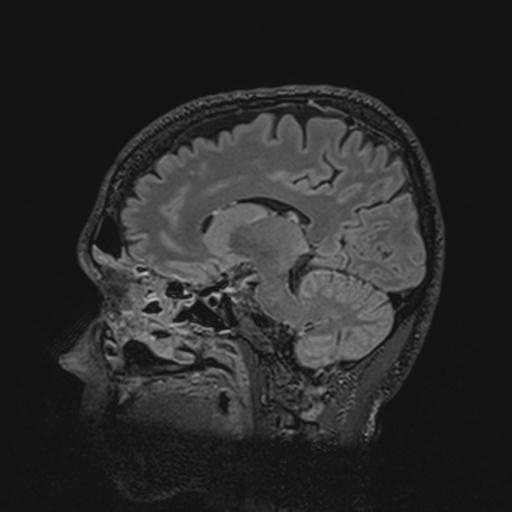 File:Autoimmune limbic encephalitis (Radiopaedia 30363-31005 Sagittal FLAIR 92).jpg