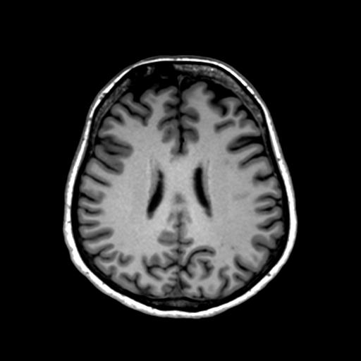 Autoimmune limbic encephalitis (Radiopaedia 30363-31005 T1 Axial 1mm 98).jpg
