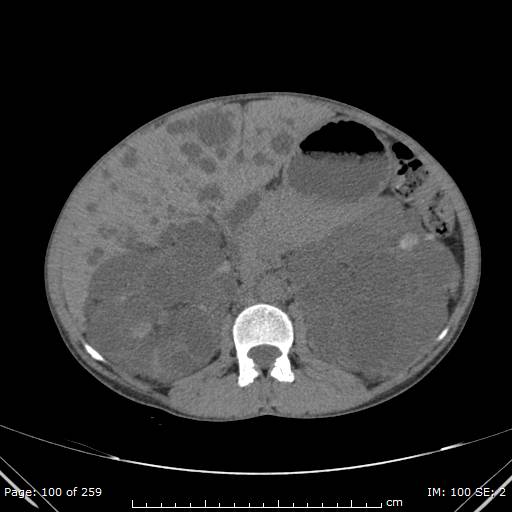 File:Autosomal dominant polycystic kidney disease (Radiopaedia 44122-47684 Axial 23).jpg