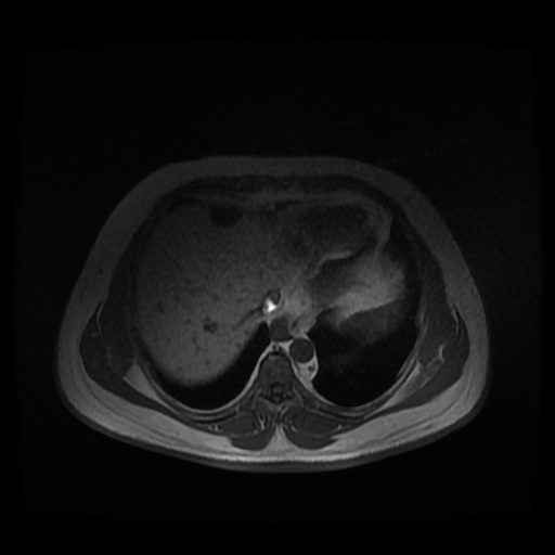 Autosomal dominant polycystic kidney disease (Radiopaedia 50259-55611 Axial 2D Dual Echo 12).jpg