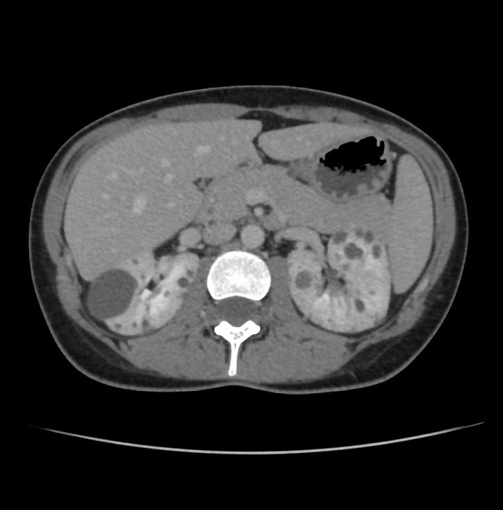 Autosomal dominant polycystic kidney disease - early onset (Radiopaedia 40734-43387 A 24).jpg