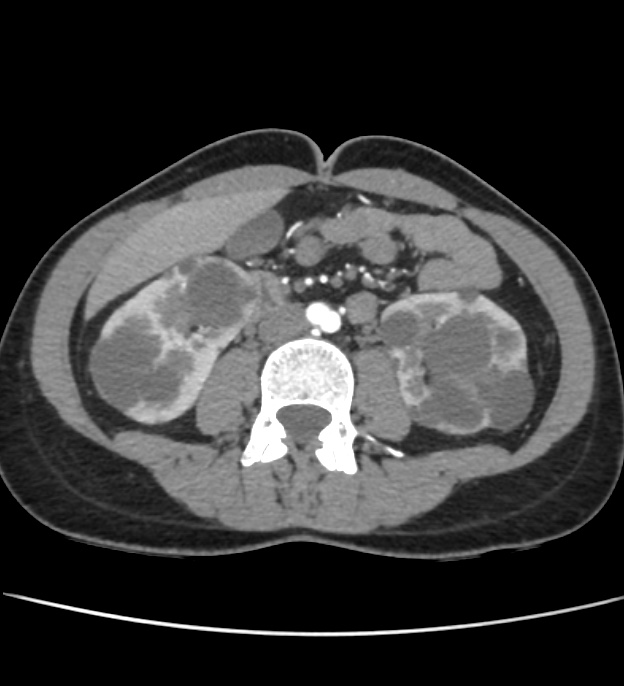 Autosomal dominant polycystic kidney disease - early onset (Radiopaedia 40734-43387 B 38).jpg