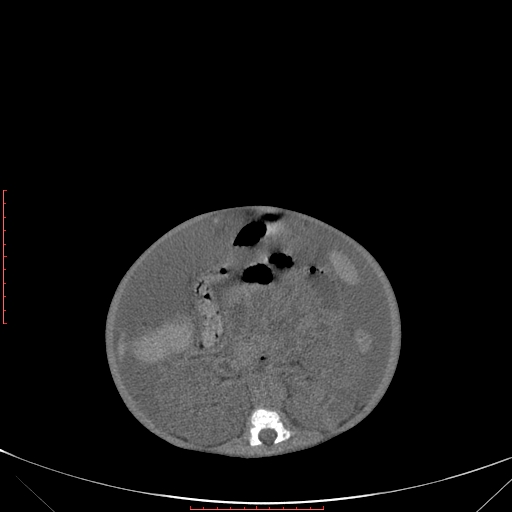 Autosomal recessive polycystic kidney disease associated with Caroli disease (Radiopaedia 61932-69984 Axial non-contrast 214).jpg