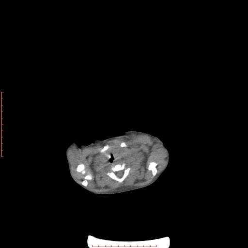 File:Autosomal recessive polycystic kidney disease associated with Caroli disease (Radiopaedia 61932-69984 Axial non-contrast 7).jpg