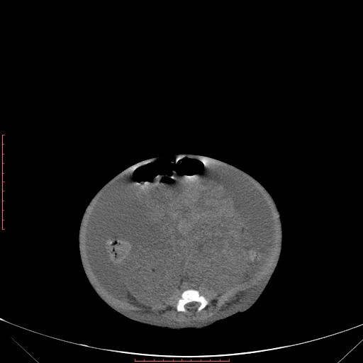 File:Autosomal recessive polycystic kidney disease associated with Caroli disease (Radiopaedia 61932-69984 B 255).jpg