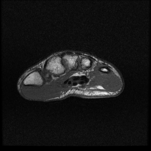 File:Avascular necrosis - scaphoid non-union (Radiopaedia 63457-72065 Axial T1 1).jpg